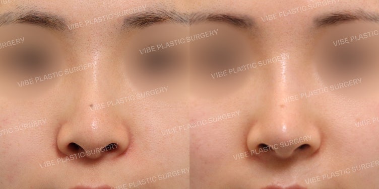 The Destination for Rhinoplasty Revision :D
