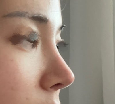 Nose Revision Surgery Hotspot :D 사진 8