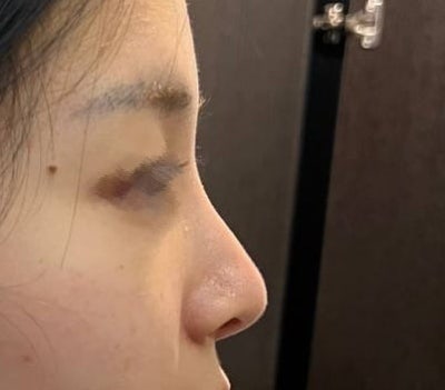 Nose Revision Surgery Hotspot :D 사진 7