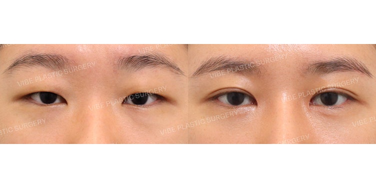 ทำตาสองชั้นแบบกรีดบางส่วน เพื่อผลลัพธ์ที่ดูเป็นธรรมชาติและคมชัด :D