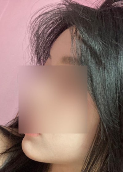 지방이식으로 생기있고 앳된 얼굴형 완성 ! 사진 12