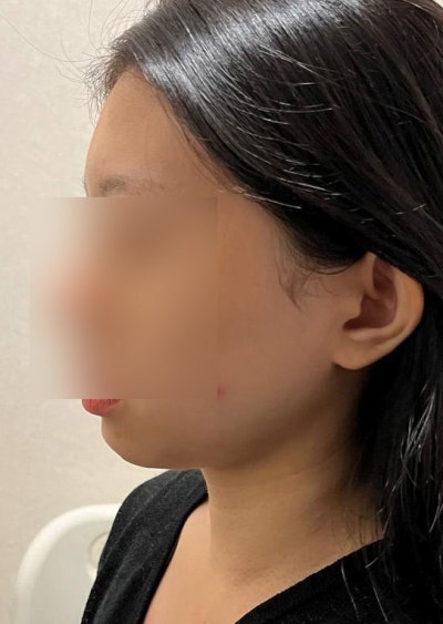 지방이식으로 생기있고 앳된 얼굴형 완성 ! 사진 11