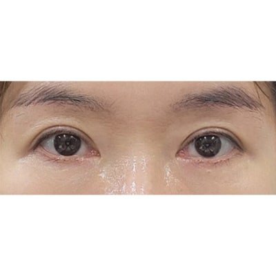 Brow Lift and Natural Adhesion Double Eyelid Surgery! 사진 7