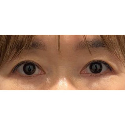 Brow Lift and Natural Adhesion Double Eyelid Surgery! 사진 6