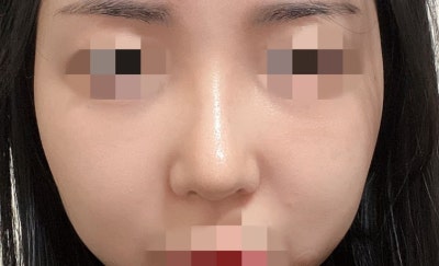 取出HIKO线后进行鼻部整形! 사진 8