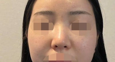 取出HIKO线后进行鼻部整形! 사진 7
