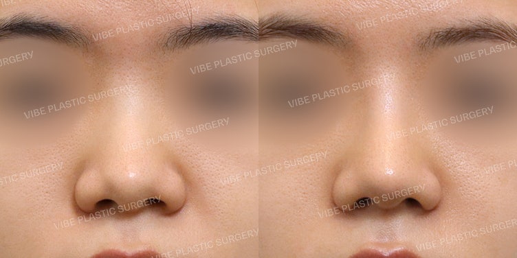 Transformasi Sempurna Hidung Pesek dan Lebar!