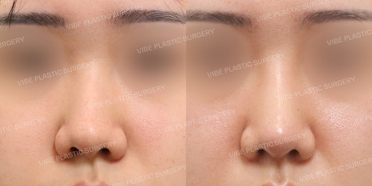 Koreksi Alami untuk Hidung Lebar (Bulbous Nose)!