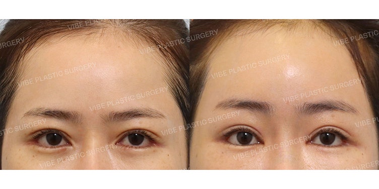 การผ่าตัดยกคิ้วและหน้าผากผ่านกล้อง (Endoscopic Forehead Lift)