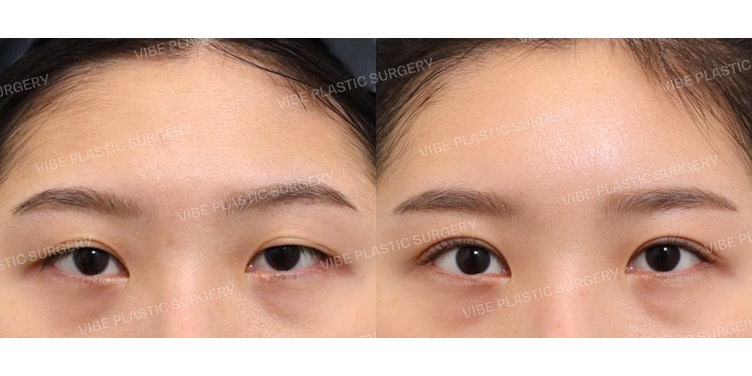 เปลี่ยนลุคให้ดูสดใสด้วยการแก้ตาสองชั้น! (+ ฉีดไขมันหน้าผาก)