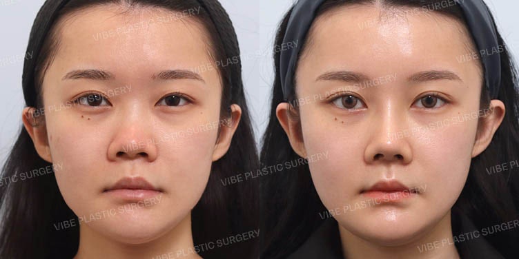 การเปลี่ยนแปลงครั้งใหญ่ของจมูกชมพู่ที่สั้น!! ที่ VIBE Plastic Surgery :D