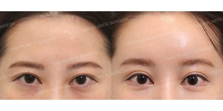 Achieving a Refreshed Look with Forehead Lift and Revision Eye Surgery :D