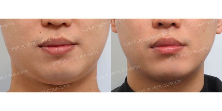تحقيق خط فك مثالي (V-line) عبر إزالة دهون الخد العميقة وشفط الدهون!!