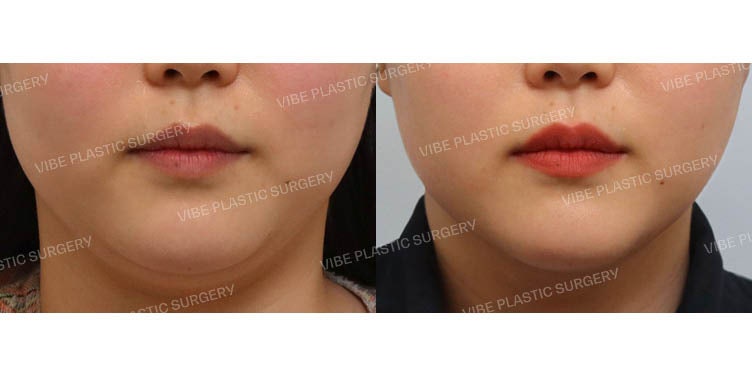 اكتشفوا فعالية شفط الدهون بالموجات فوق الصوتية (LipoSound) في عيادة فايب للتجميل!