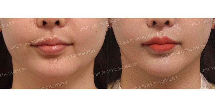 ผลลัพธ์ของ LipoSound ที่ VIBE Plastic Surgery!