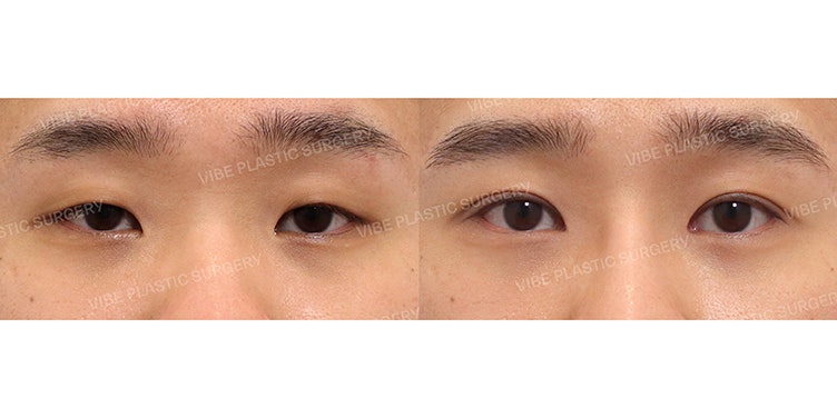 แก้ไขกล้ามเนื้อตาผู้ชาย เพื่อดวงตาที่ดูคมชัดและสดใส!
