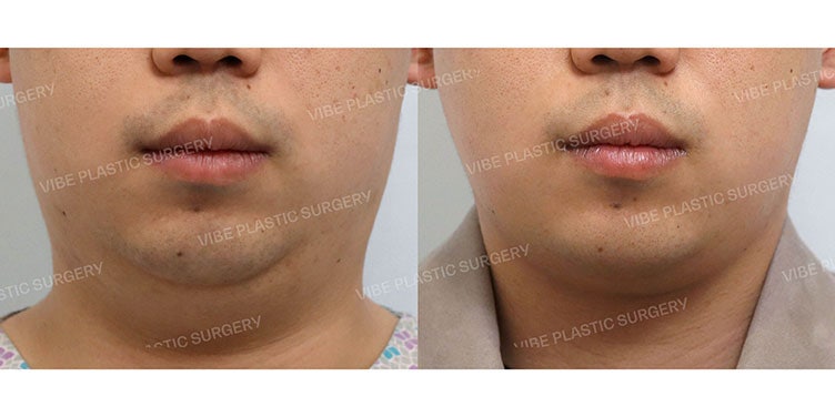 علاج الذقن المزدوجة للرجال أيضاً في عيادة فايب للتجميل!