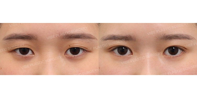 สร้างดวงตาที่กลมโตและสดใสด้วยการปรับกล้ามเนื้อตาแบบกรีดจุด (Partial Incision) :D