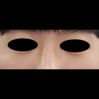 눈밑 지방 재배치로 다크써클 뿌시기 !! 사진 5