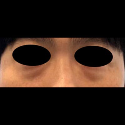 눈밑 지방 재배치로 다크써클 뿌시기 !! 사진 4