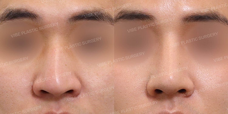 VIBE Rhinoplasty: Improving Both Aesthetics and Function!