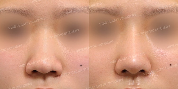 ศัลยกรรมจมูกชมพู่ที่ VIBE Plastic Surgery!