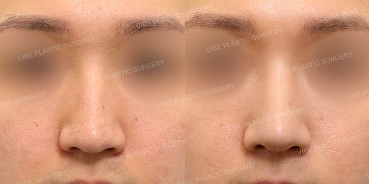 عملية تجميل الأنف للرجال بدون غرسات صناعية في عيادة فايب (VIBE) :D