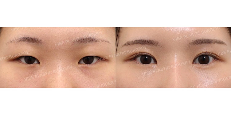 เปลี่ยนลุคให้ดูสวยคมและสดใสด้วยการทำตาสองชั้น! (เทคนิคกรีดตาสองชั้น)