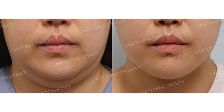 Hãy kiểm tra hiệu quả của hút mỡ Lipo Sound!