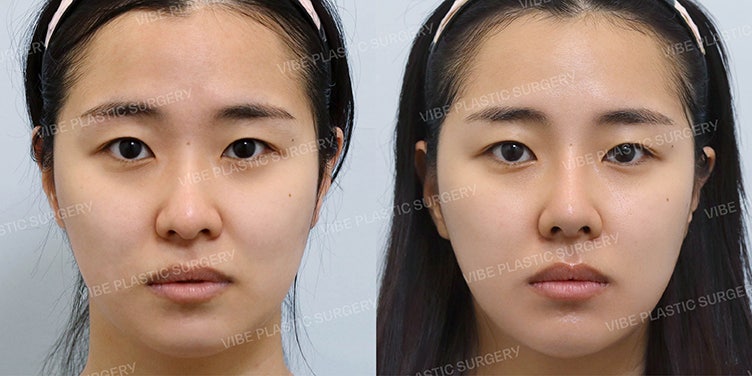 احصل على خط أنف مستقيم وطبيعي في عيادة فايب للتجميل! (+ تجميل الأنف الوظيفي)