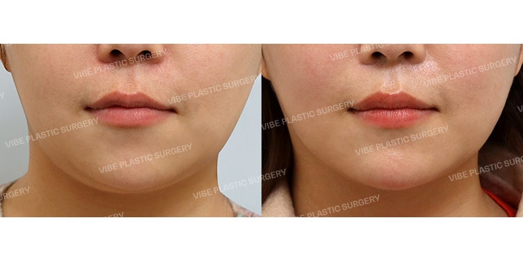 ดูดไขมันกรอบหน้า V-Line ต้องที่ VIBE Plastic Surgery!
