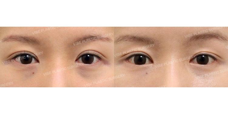 Kỹ thuật hạ đường mí (Dujultagi) ?! Chỉnh sửa mắt xúc xích ?! Tại Vibe Plastic Surgery !