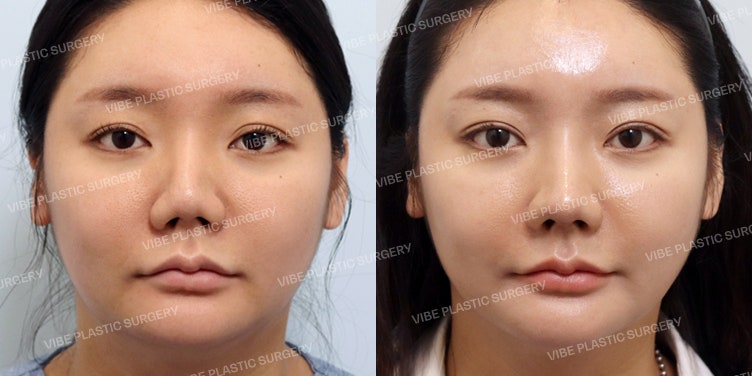 Phẫu thuật chỉnh sửa mũi to lần thứ 3 bằng sụn sườn tự thân !!