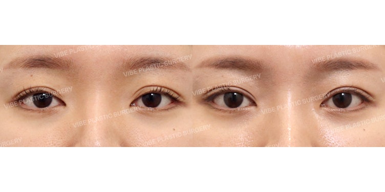 Achieve a Sophisticated Semi-Out Line at VIBE Plastic Surgery!