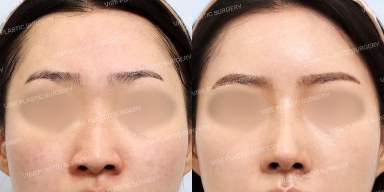 Deviated & Long Nose Correction with Forehead Fat Grafting :D