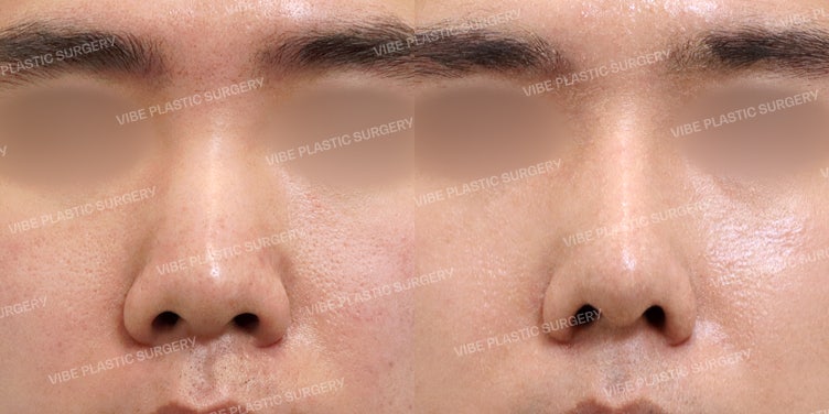 ศัลยกรรมจมูกสวยพร้อมแก้โรคภูมิแพ้!! ที่ VIBE Plastic Surgery :)