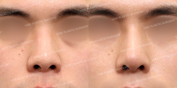 Men’s Short Nose Rhinoplasty at VIBE Plastic Surgery! (feat. BBU TV)