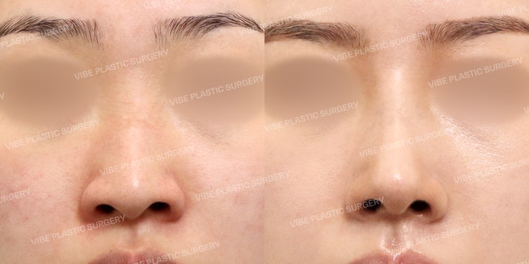 ศัลยกรรมจมูกทรงสโลปปลายพุ่งแบบธรรมชาติคืออะไร?! VIBE Plastic Surgery :D