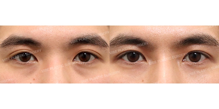 Natural Hidden Double Eyelid Ptosis Correction for Men!