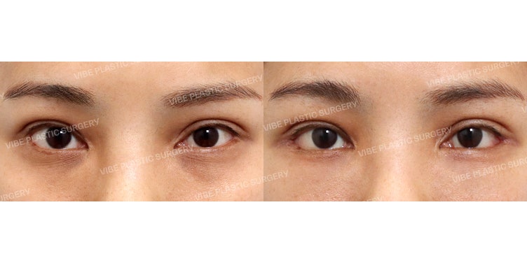 Нүдний гадна булан нээх (Dual Canthoplasty) болон нүдний доорх өөх дахин хуваарилах мэс засал