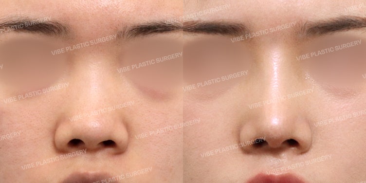 Correcting a Short, Bulbous Nose: Can I Get a Nose Like Kim Yoo-jung? | Dr. Yoo Young-moon, VIBE Plastic Surgery