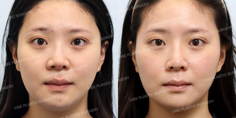 Garis Hidung Lurus-Melengkung (Straight-half-curved) Cantik Mirip Kim Ji-young Heart Signal! (Rhinoplasty Tulang Rawan Iga Autologus)