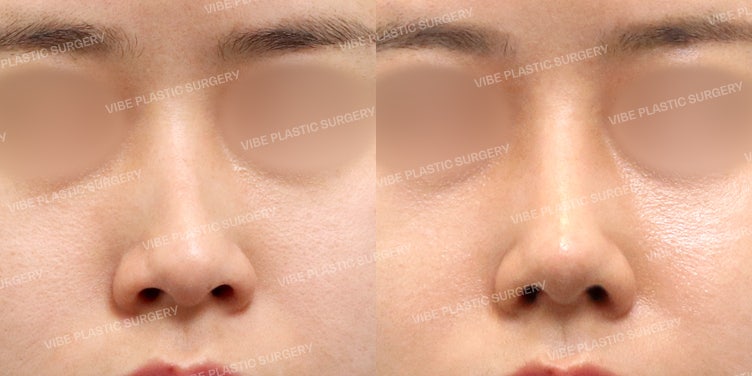 VIBE Plastic Surgery’s ‘Absolutely’ No-Implant Rhinoplasty!!