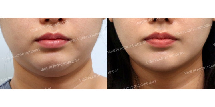 สร้างกรอบหน้า V-Line ให้เรียวสวยด้วยการดูดไขมัน ‘LipoSound’ และ ‘การตัดไขมันกระพุ้งแก้ม’ :D