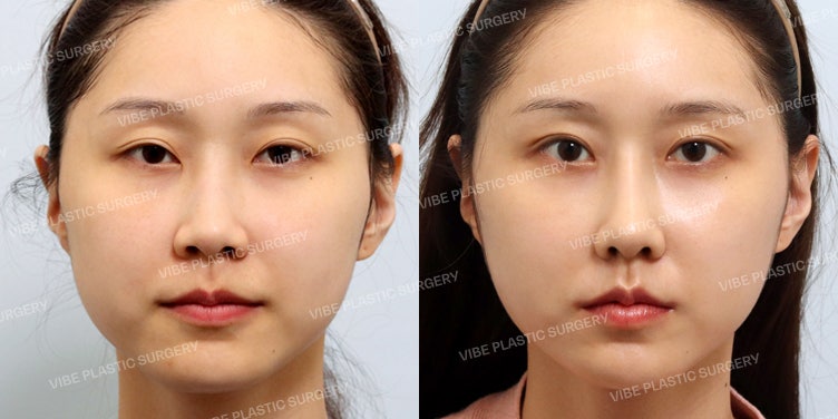 แก้ไขตาหอยแครงด้วยเทคนิค Du-jul-tta-gi (แก้รอบที่ 3) พร้อมเสริมจมูก ปรับลุคให้ดูสวยหวานน่ารัก :D