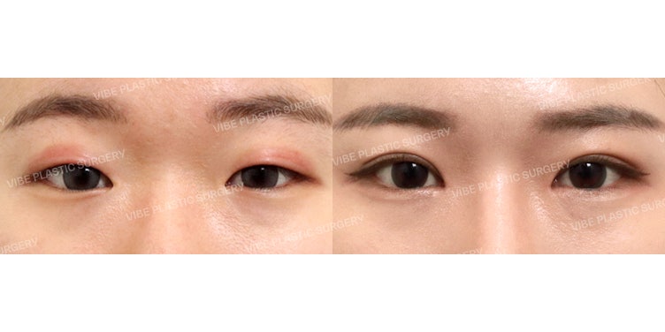 Jangan Gunakan Selotip Kelopak Mata (Eyelid Tape)!!