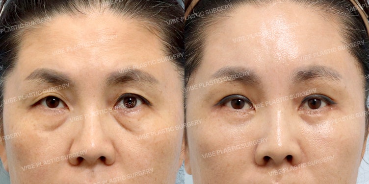 Jangan Sembarangan Melakukan Blefaroplasti Atas!! (Endoscopic Brow Lift, Blefaroplasti Bawah + Midface Lift)