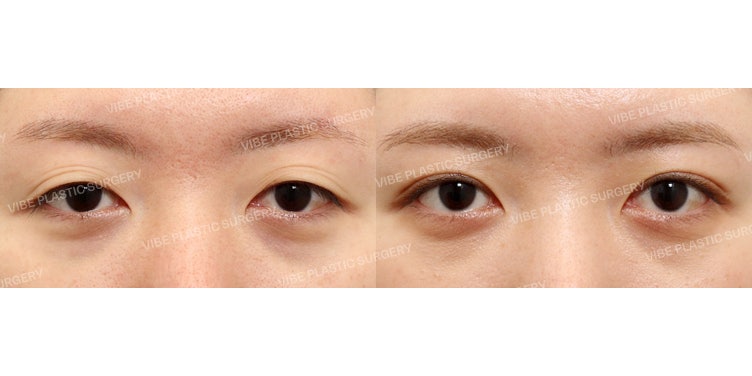 เมื่อรอยพับเปลือกตาหลายชั้นกวนใจ ลองเช็กดูว่ากล้ามเนื้อตาอ่อนแรงหรือไม่!