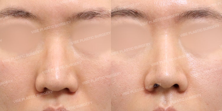 VIBE Plastic Surgery is ‘the’ Choice for No-Implant Rhinoplasty
