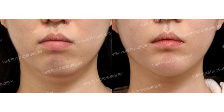 แก้ไขคางสั้นและกรอบหน้าไม่ชัดเจนที่ VIBE Plastic Surgery!